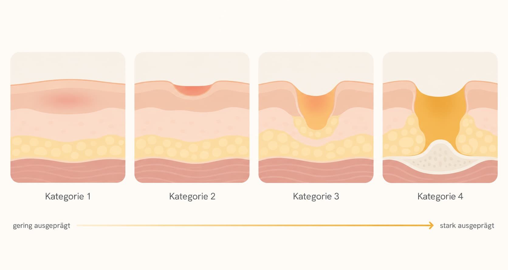 Schematische Darstellung der vier Dekubitus-Kategorien
